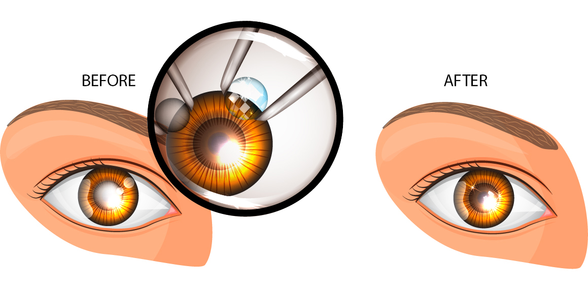 Eye Lens Replacement Surgery miragedesignhub