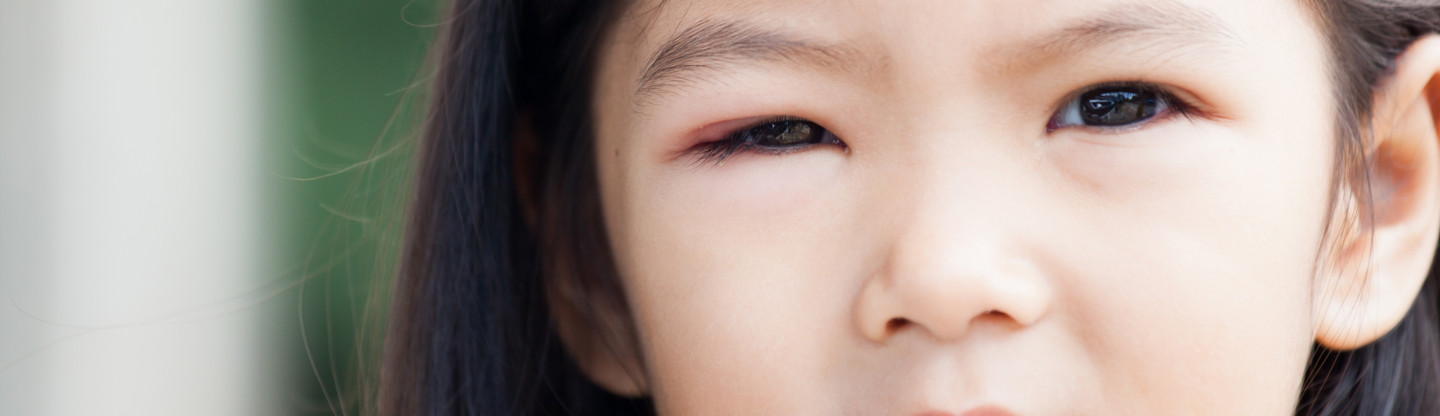 Conjunctivitis Pediatric Ophthalmology Spokane Eye Clinic v2