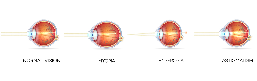 asztigmatizmus hyperopia myopia